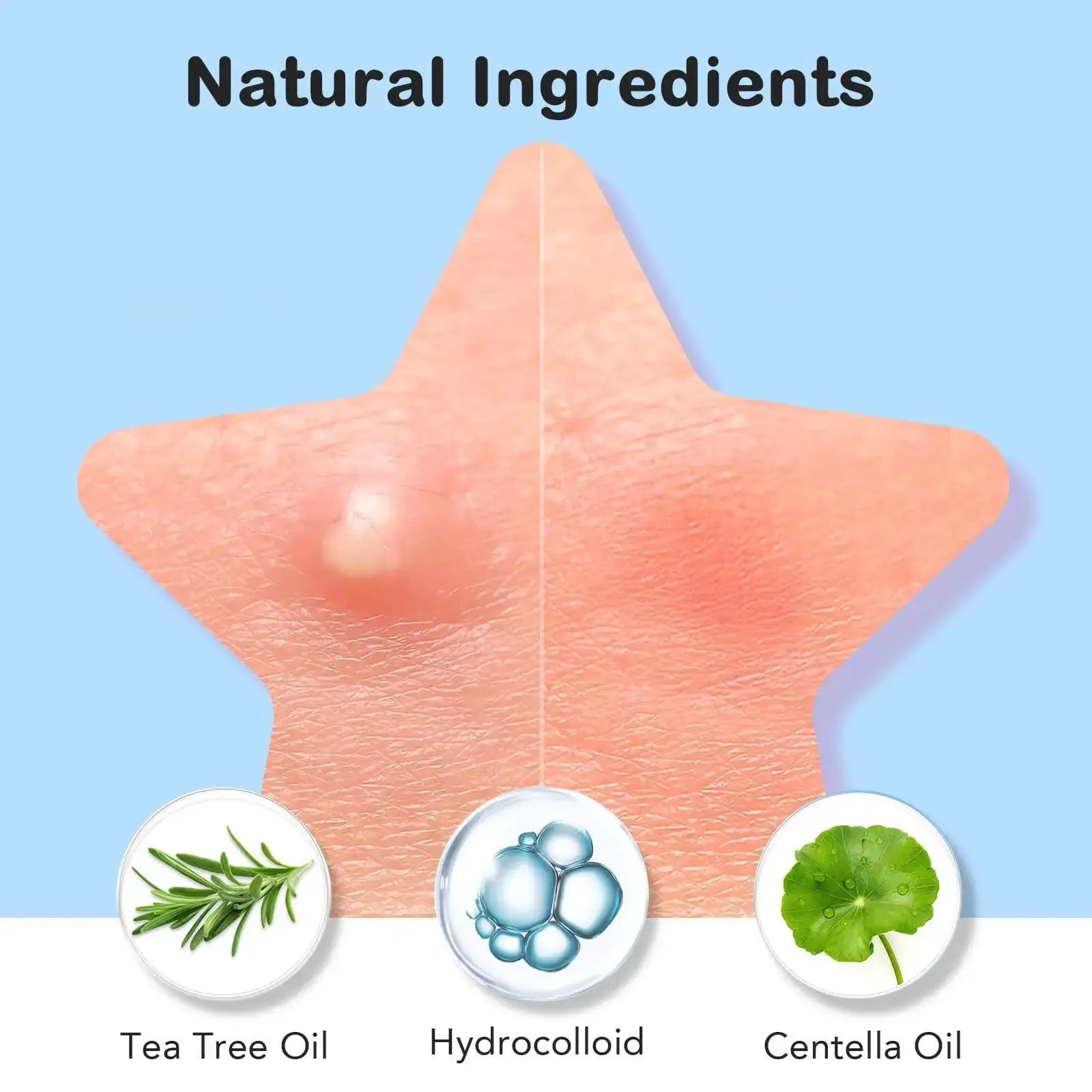 Star Acne Patches 240/480/720 Pieces, High-Quality Emergency Kit, Invisible Hydrogel Absorbs Pus Quickly, Reduces Swelling, Cute by All Mart Bristol Ltd