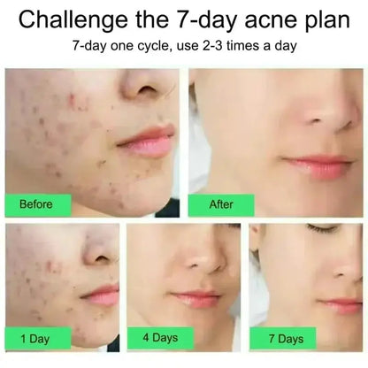 Salicylic Acid Acne Treatment Face Cream Repair Pimple Spots Deep Cleaning Pore Anti-acne Scar Oil Control Moisturizer Skin Care by All Mart Bristol Ltd