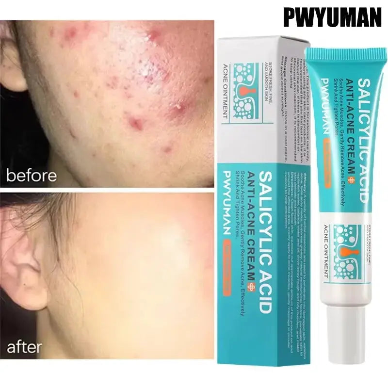 Salicylic Acid Acne Treatment Face Cream Repair Pimple Spots Deep Cleaning Pore Anti-acne Scar Oil Control Moisturizer Skin Care by All Mart Bristol Ltd