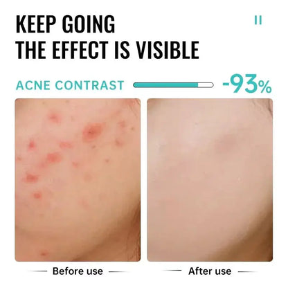Salicylic Acid Acne Treatment Face Cream Repair Pimple Spots Deep Cleaning Pore Anti-acne Scar Oil Control Moisturizer Skin Care by All Mart Bristol Ltd