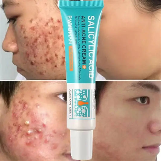 Salicylic Acid Acne Treatment Face Cream Repair Pimple Spots Deep Cleaning Pore Anti-acne Scar Oil Control Moisturizer Skin Care by All Mart Bristol Ltd